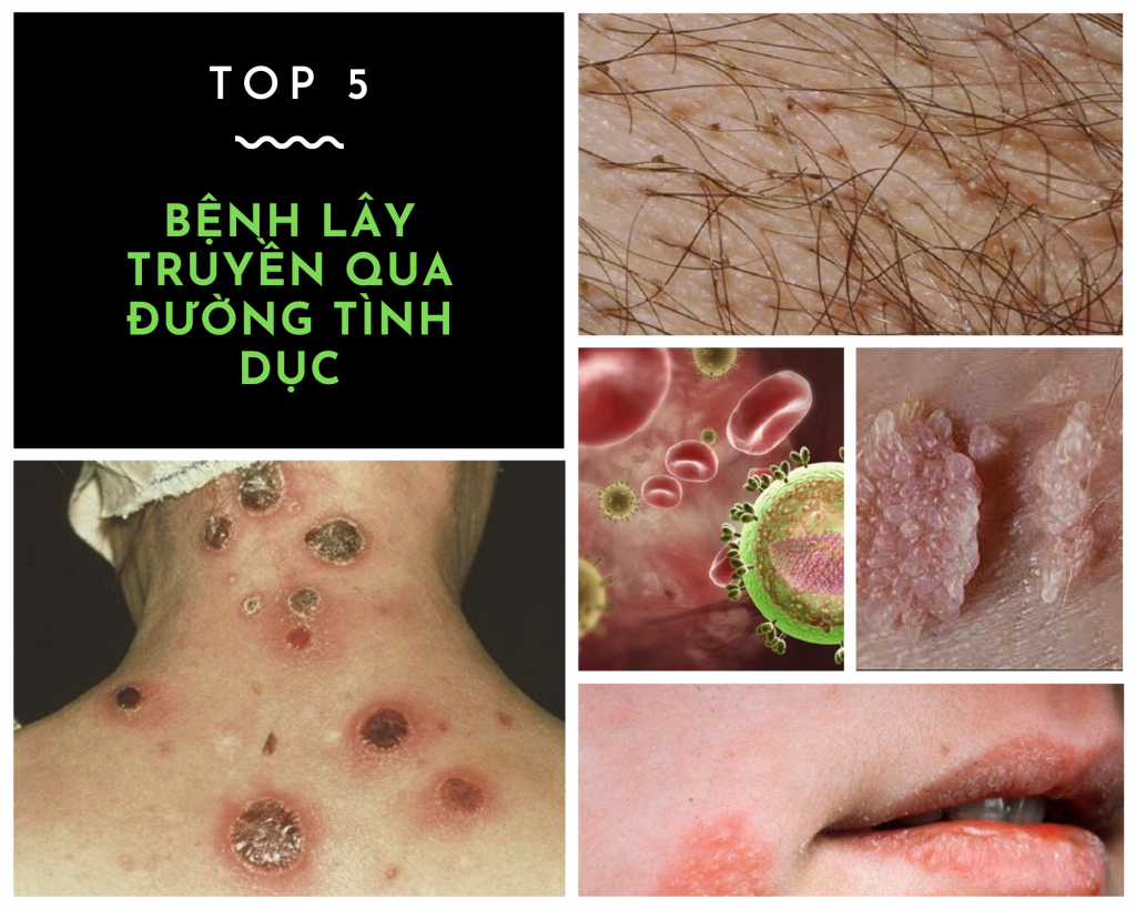 benh-lay-truyen-qua-duong-tinh-duc